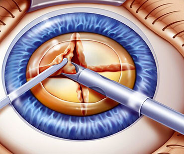 Cataract (Phaco)